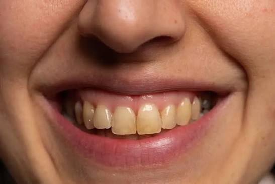 How To Get Rid Of A Dark Brown Stain On Your Teeth With These Simple Trick